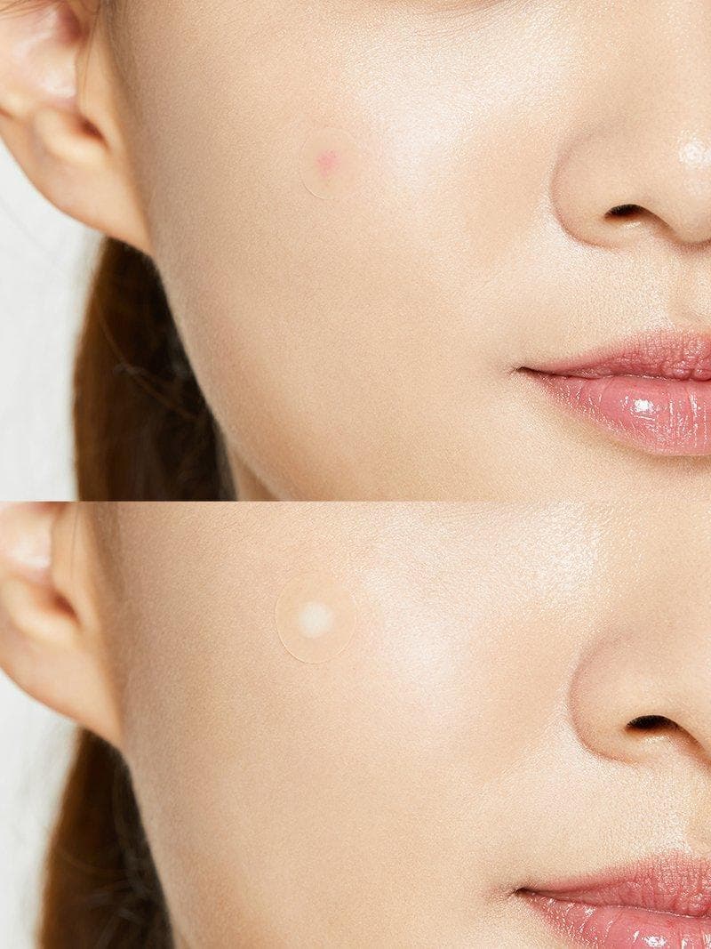 Acne Pimple Master Patch — view 3